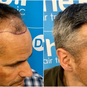 before-11-months-2148-fue-hair-dr-right.jpg
