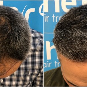 before-11-months-2148-fue-hair-dr-top.jpg