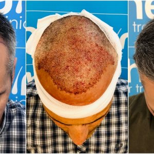 before-placement-11-months-2148-fue-hair-dr-top.jpg