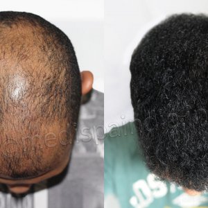 curly hair transplant at Medispa