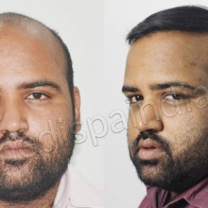 Best hair transplant results in India
