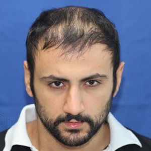 identical twin hair transplant 6.jpg