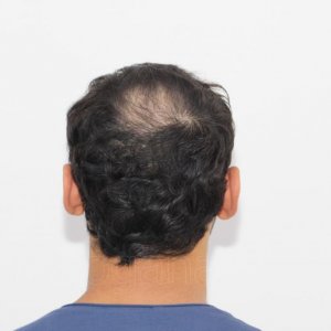 Identical twin hair transplant 23.jpg