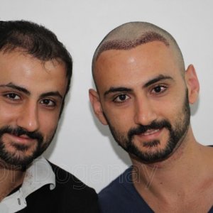 Identical twin hair transplant 38.jpg