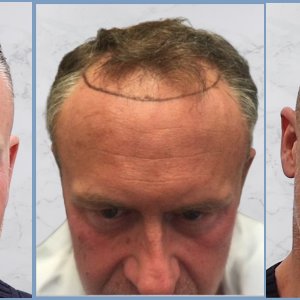 collage-before.result-dr-nikos-hair-tranplant.jpg