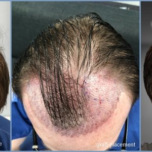 before-hair-placement-5-months-dr-nikos.jpg