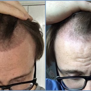post-op-healing-dr-nikos-hair-transplant.jpg
