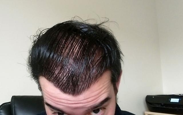 My updates post hair transplant surgery | Page 8 | Hair loss Forum - Hair  Transplant forums