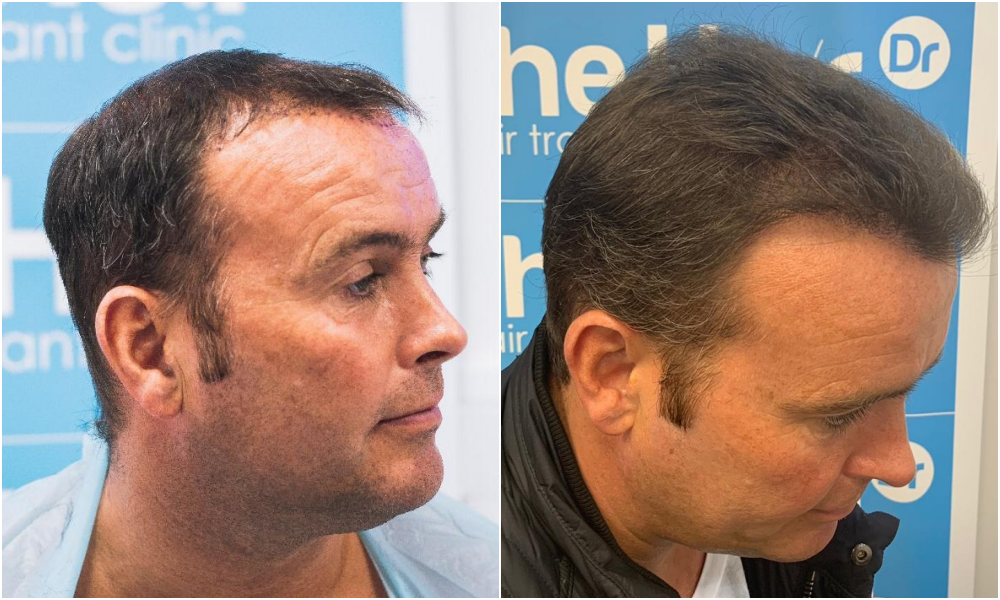 2. before-after-right. ben-thornley.png