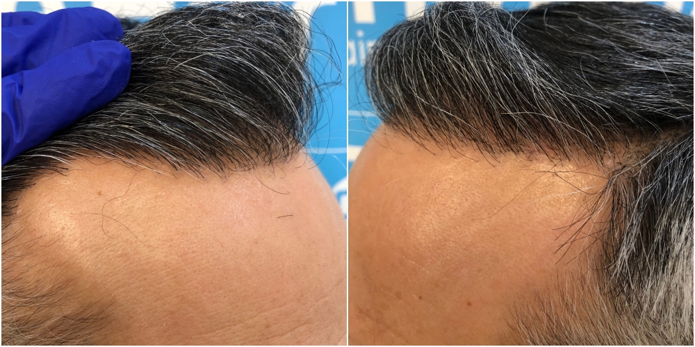 2148-fue-hair-dr-hairline.jpg