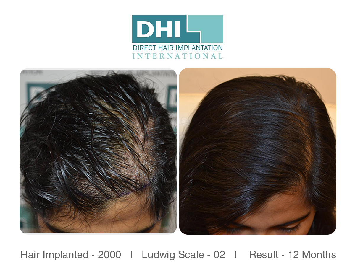 27 Year Old Female Hair Transplant Life Changing Journey