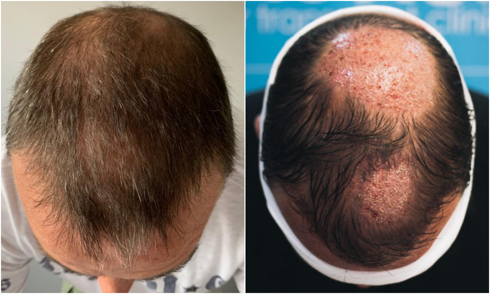 5. before-placement-top-ben-thornley.png