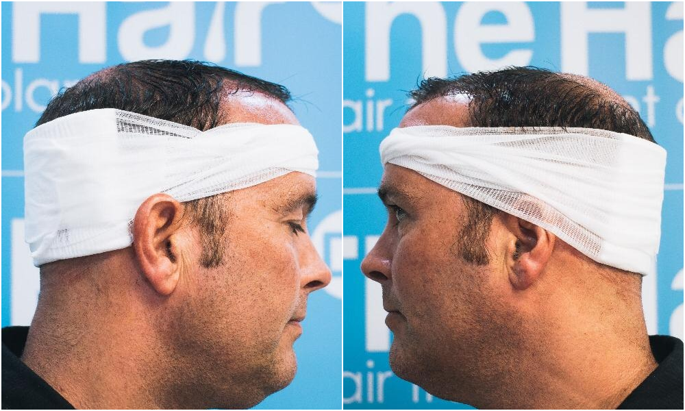 6. before-placement-sides-ben-thornley.png