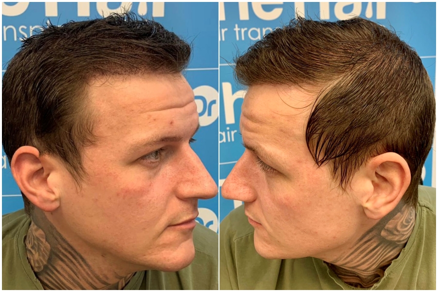 after-dr-arshad-hair-dr-fue-hair-transplant-left-right.face.jpg