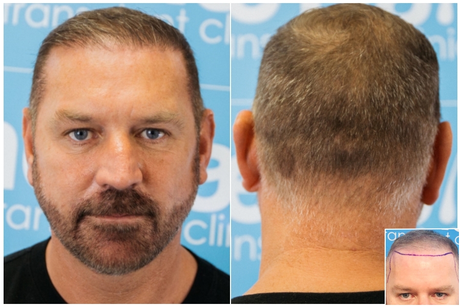 after-hairline-donor-before-dr-arshad-fue-hair-dr.jpg
