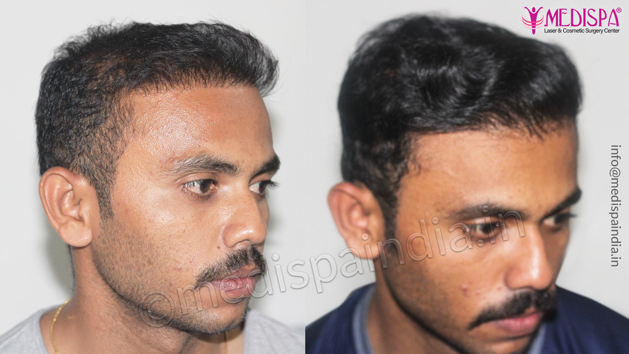 Bad Hair Transplant Repair at Medispa - Dr Suneet Soni