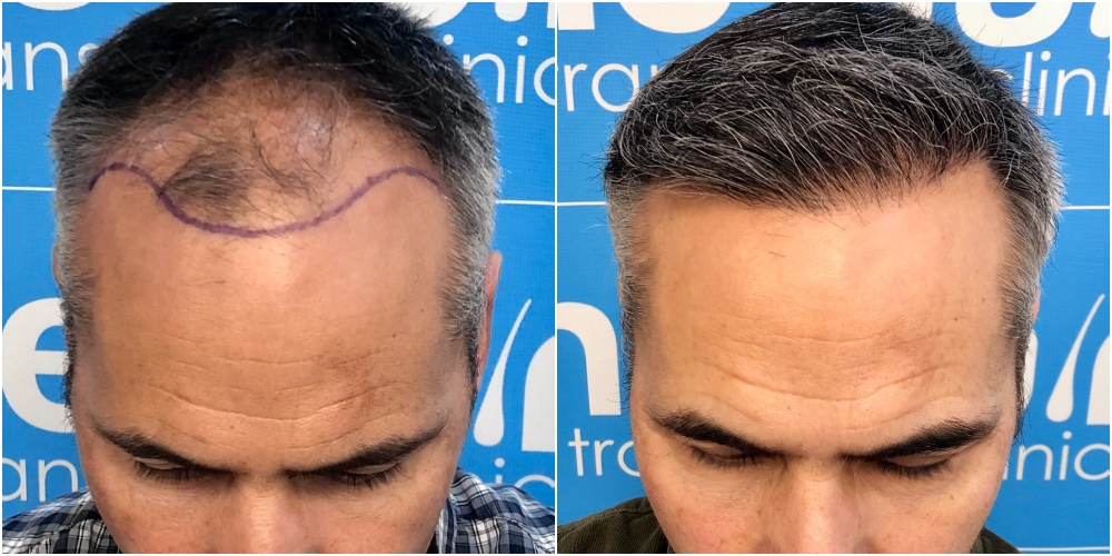 before-11-months-2148-fue-hair-dr-face.jpg