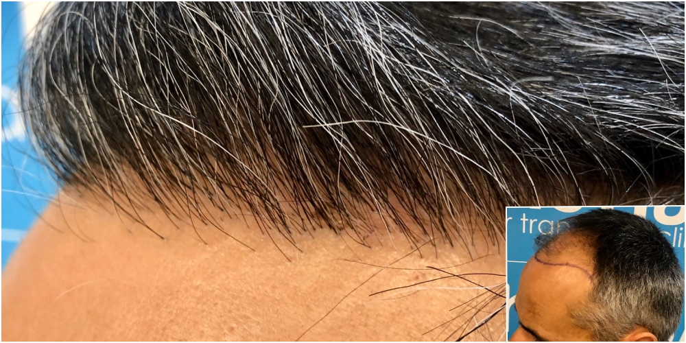 before-11-months-2148-fue-hair-dr-hailine.jpg