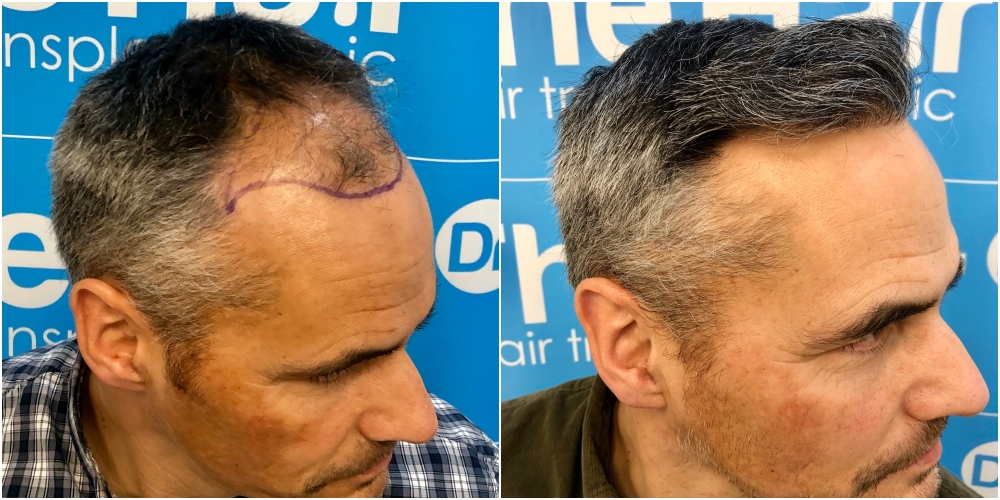 before-11-months-2148-fue-hair-dr-right.jpg
