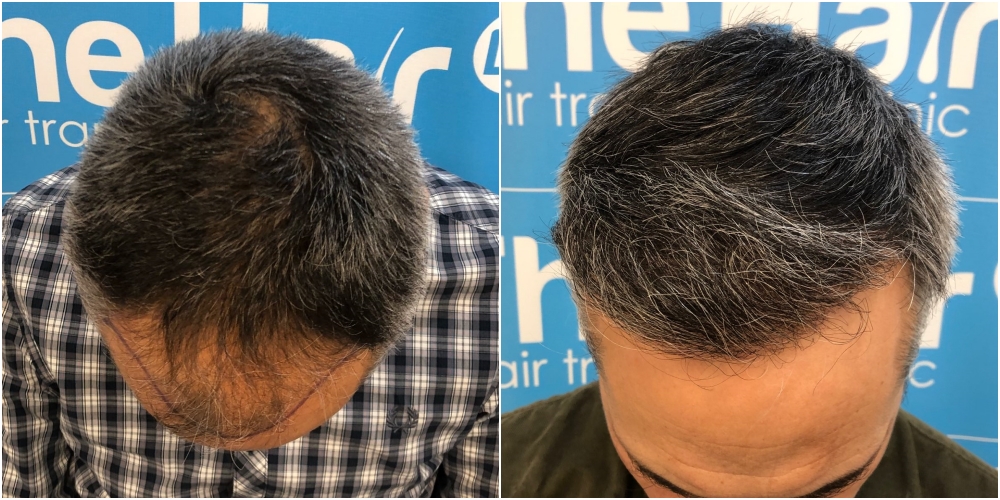 before-11-months-2148-fue-hair-dr-top.jpg