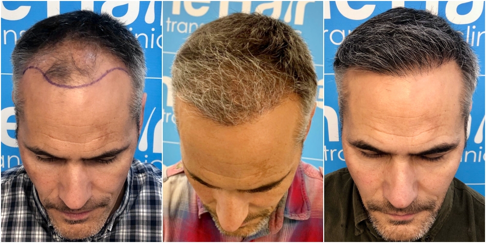 before-6-months-11-months-2148-fue-hair-dr-face.jpg