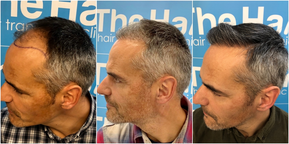 before-6-months-11-months-2148-fue-hair-dr-left.jpg