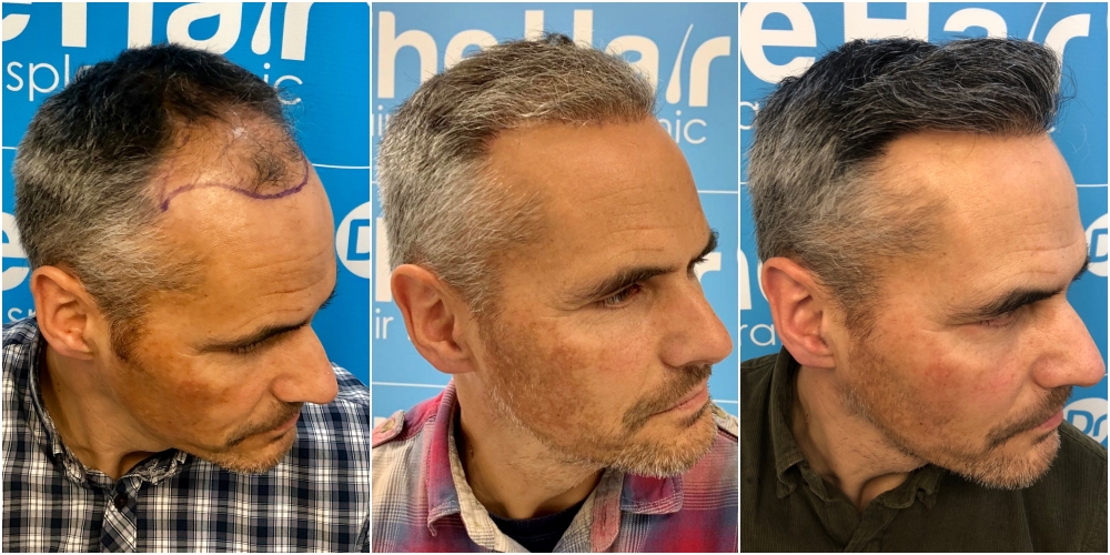 before-6-months-11-months-2148-fue-hair-dr-right.jpg
