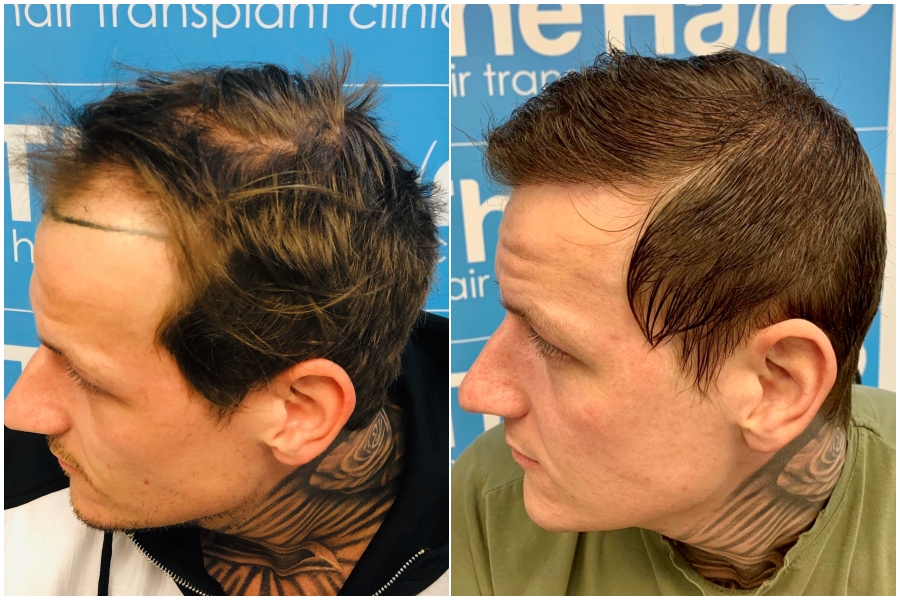 before-after-dr-arshad-hair-dr-fue-hair-transplant-left.jpg
