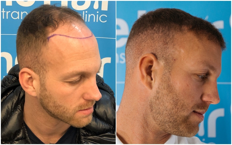 before-after-fue-hair-dr-dr-arshad-right.jpg