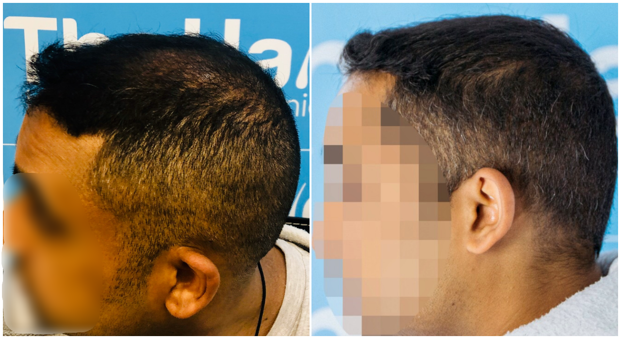 before-after-fut-hairdr-dr-arshad-left.png