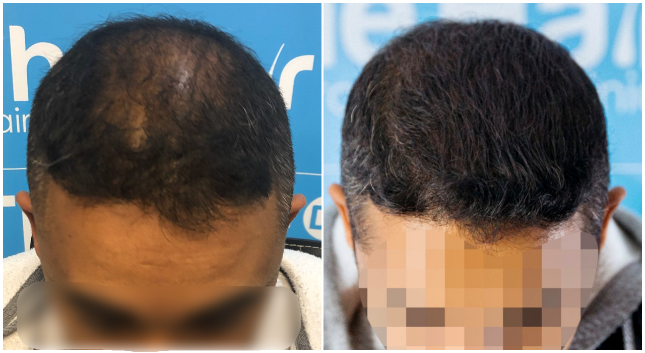 before-after-fut-hairdr-dr-arshad-top.png