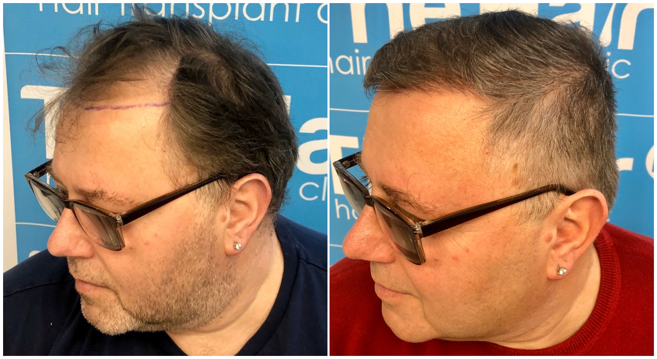 beforeafterhairdrdrarshadleft.png Hair loss Forum Hair