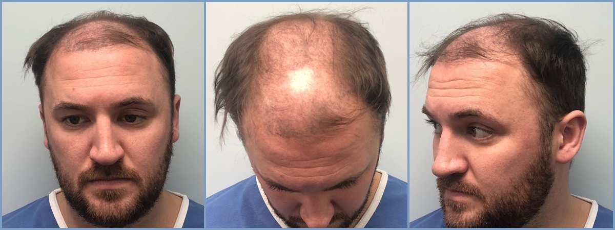 before.hair-transolant-with-dr-nikos.jpg