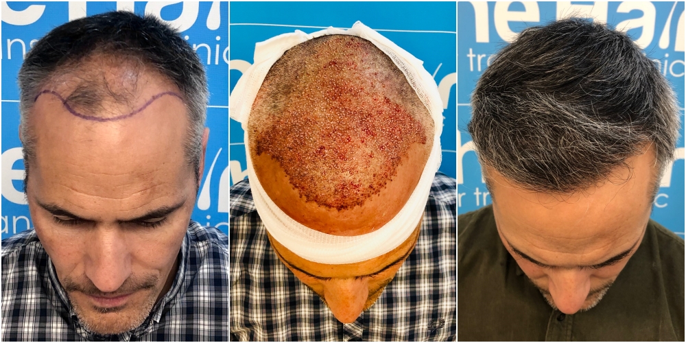 before-placement-11-months-2148-fue-hair-dr-top.jpg