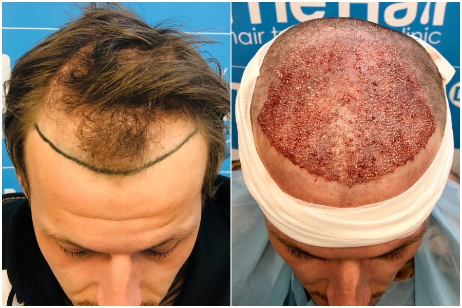2478 FUE / 0 - 7 months / Dr Arshad | Hair loss Forum - Hair Transplant  forums