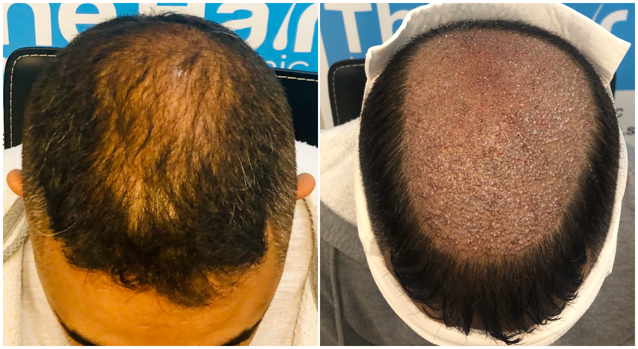 before-placement-fut-hairdr-dr-arshad-top.png