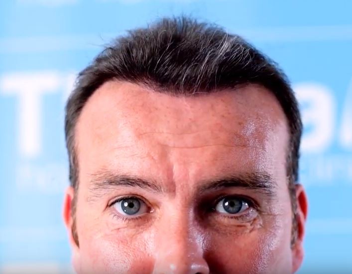 Ben-Thornley-Hair Transplant-Dr-Arshad.JPG