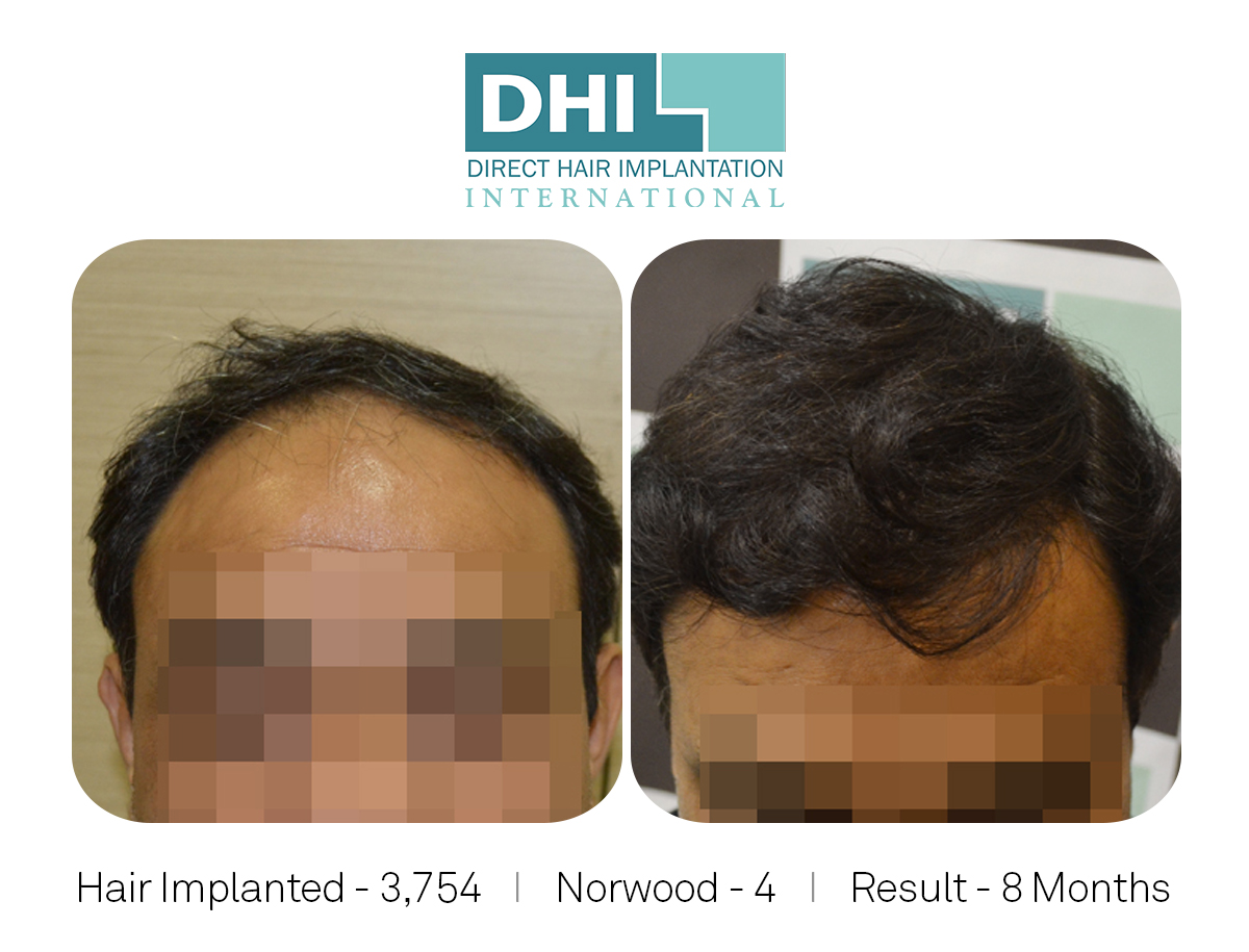 DHI - Hair Transplant Success Story 1