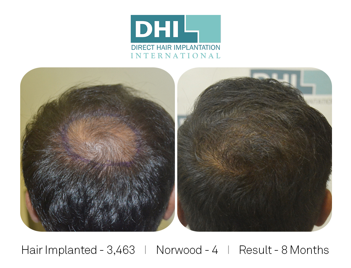 Dhi Hair Transplant Success Story Hair Loss Forum Hair