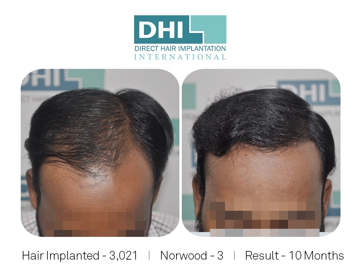 DHI Success Story 3 | Hair loss Forum - Hair Transplant forums