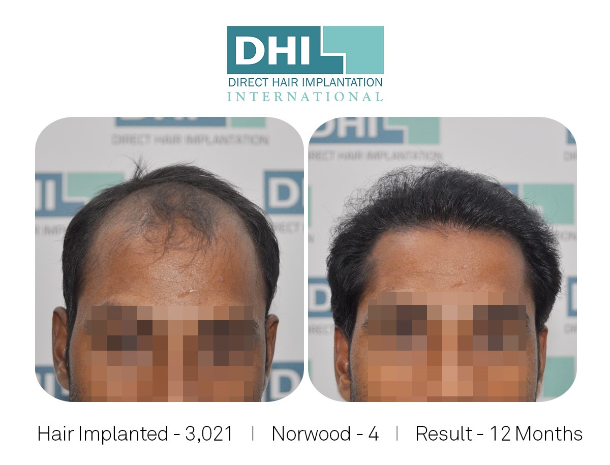 DHI Success Story   - Hair Transplant Before and After Results.