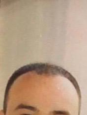 FUE :3250 GREFT BY DR. BİCER