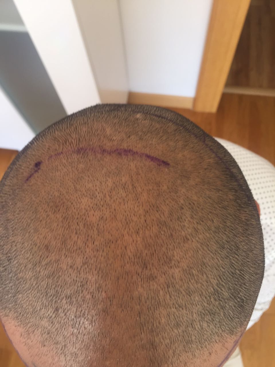 FUE 3250 GREFT BY DR. BİCER