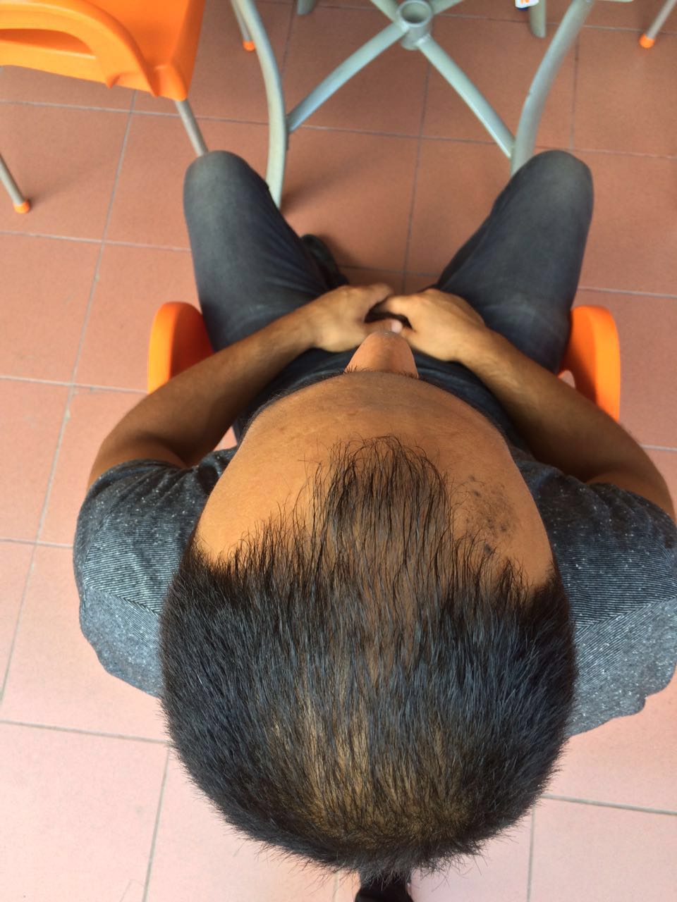 FUE 3250 GREFT BY DR. BİCER