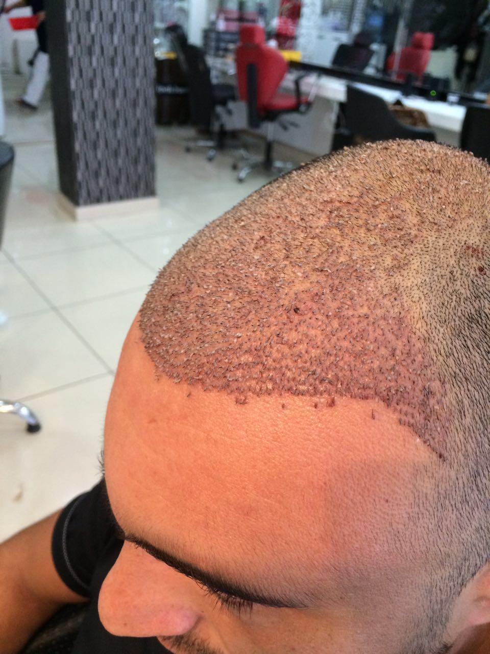 FUE 3250 GREFT BY DR. BİCER