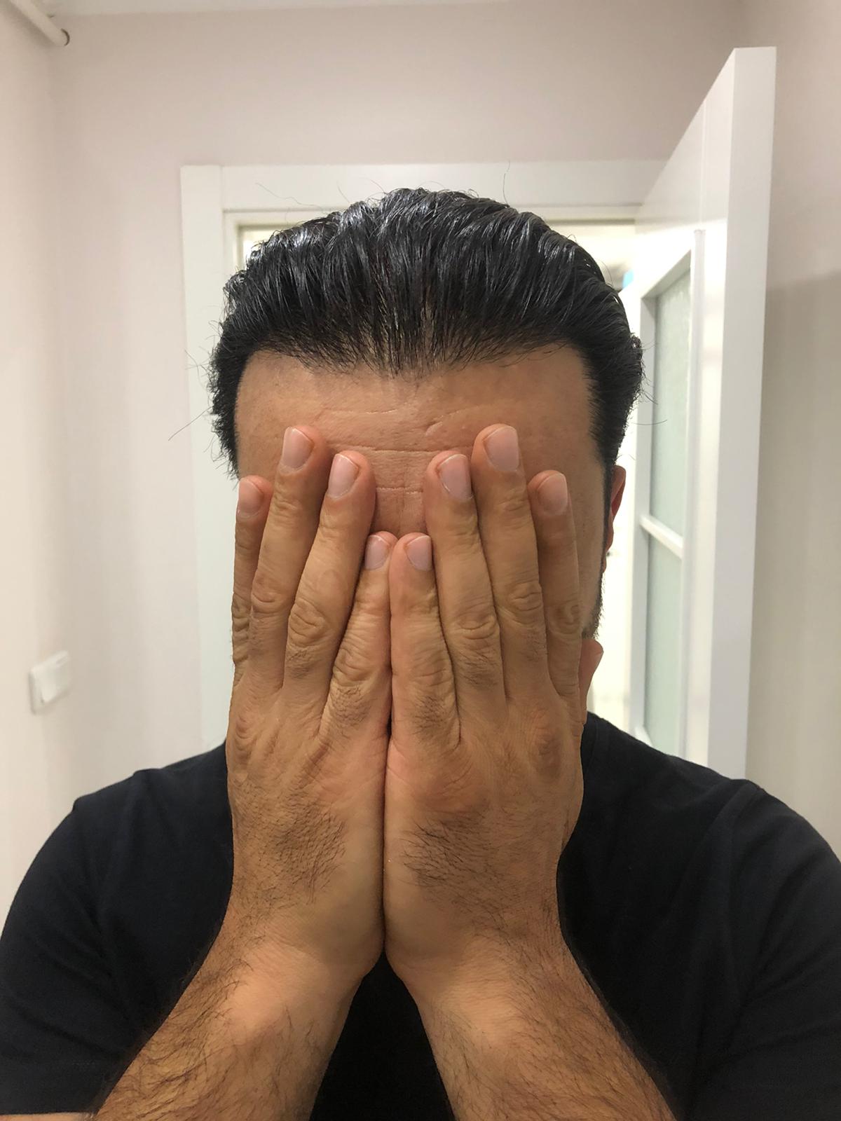 FUE 3250 GREFT BY DR. BİCER