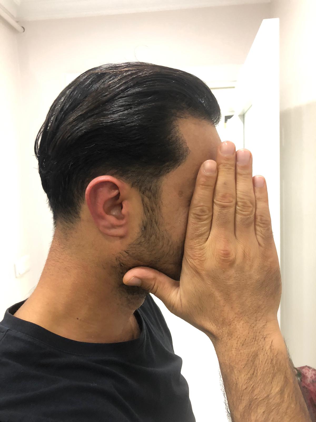 FUE 3250 GREFT BY DR. BİCER