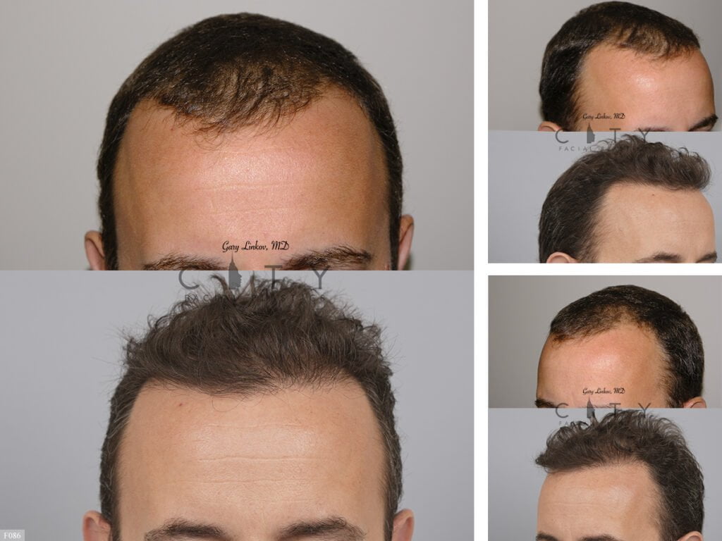 Hair-Transplant | Hair loss Forum - Hair Transplant forums
