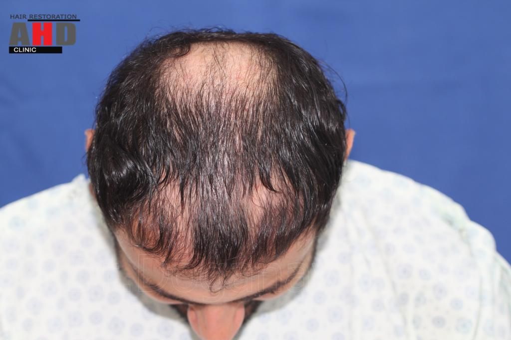 Identical twin hair transplant 10.jpg