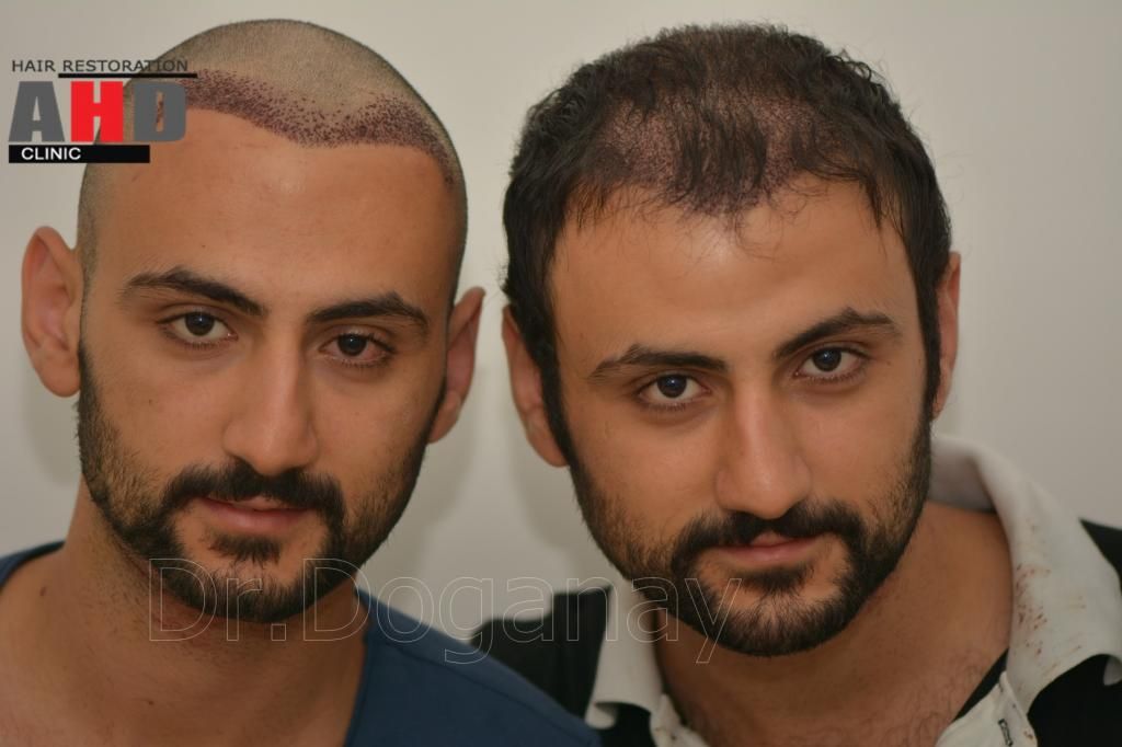 Identical twin hair transplant 37.jpg